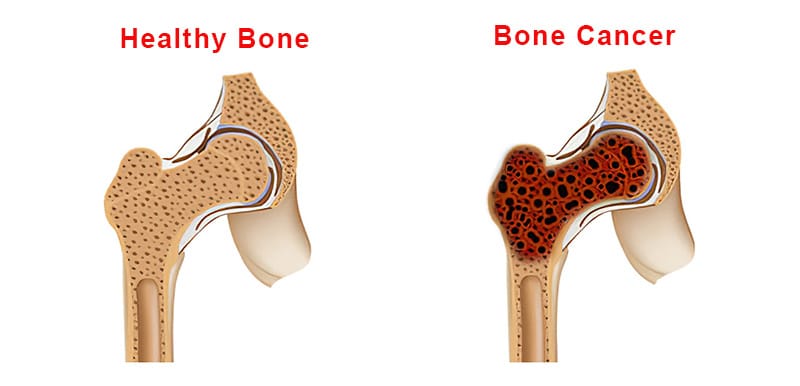 bone-cancer.jpg bone-cancer.jpg