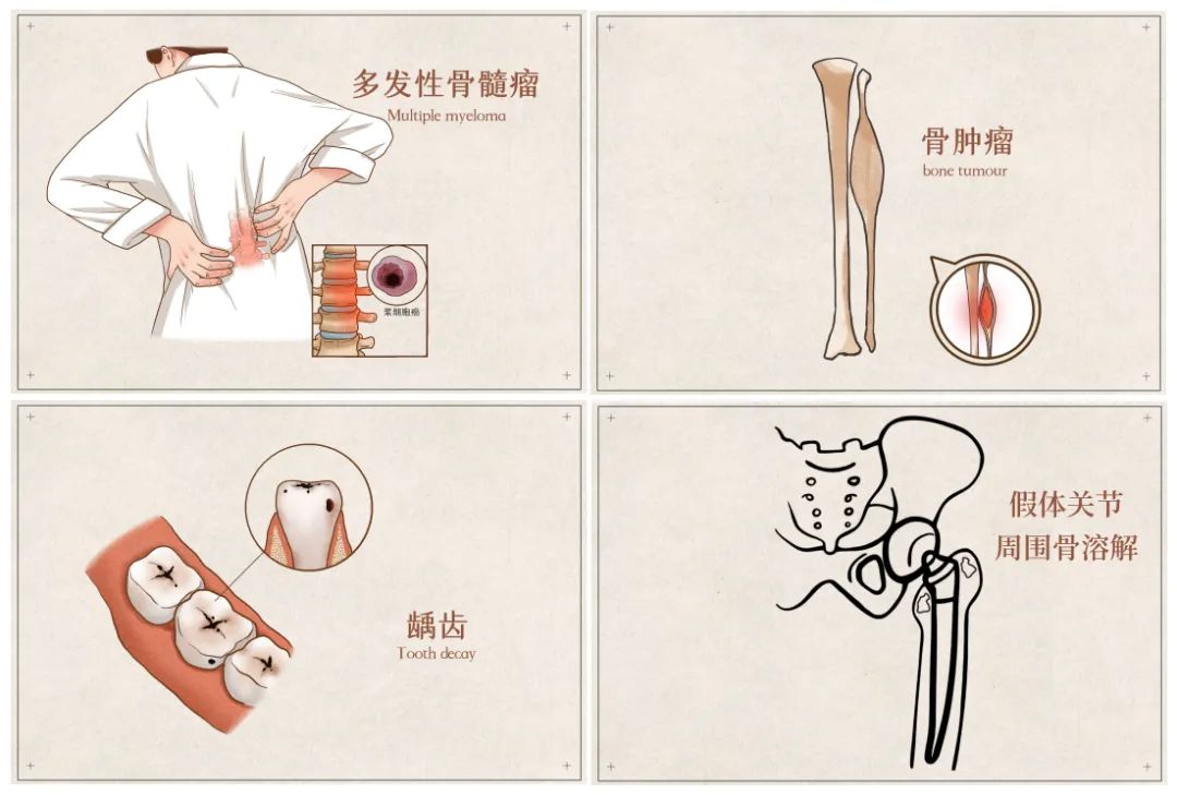 骨修复2.jpg 骨修复2.jpg