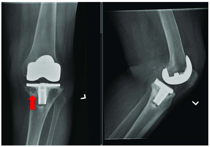 Radiographic-appearance-of-osteolysis-in-the-anteroposterior-AP-and-lateral-radiographs.png Radiographic-appearance-of-osteolysis-in-the-anteroposterior-AP-and-lateral-radiographs.png