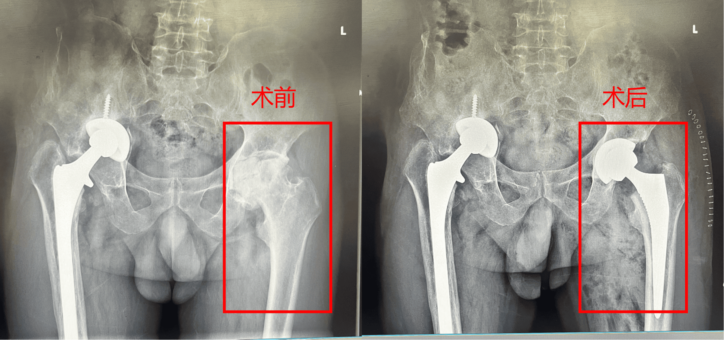 左侧全髋关节置换术前术后.png 左侧全髋关节置换术前术后.png